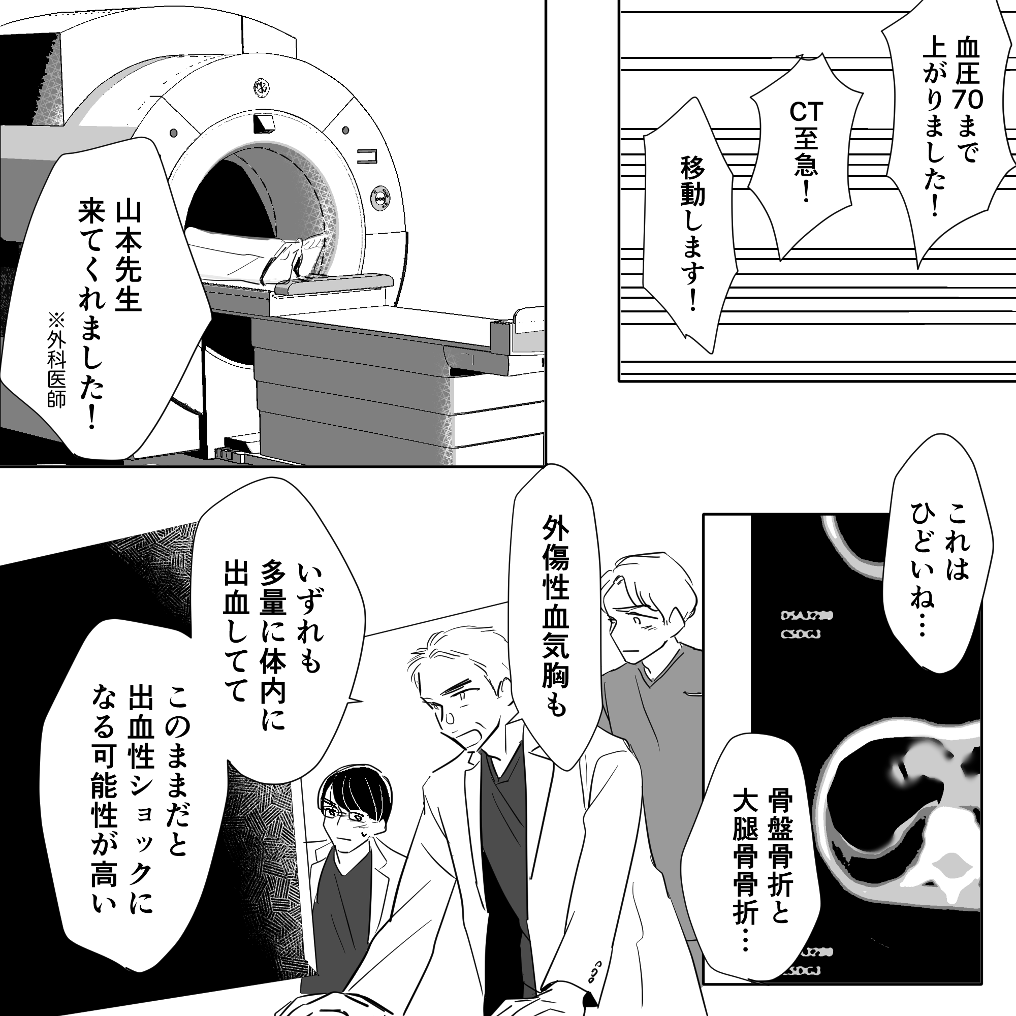 全身状態は持ち直したものの、CTを撮ると骨折や気胸など出血性ショックの危険がある